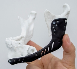 Additive Manufacturing in Implantology: A General Workflow
